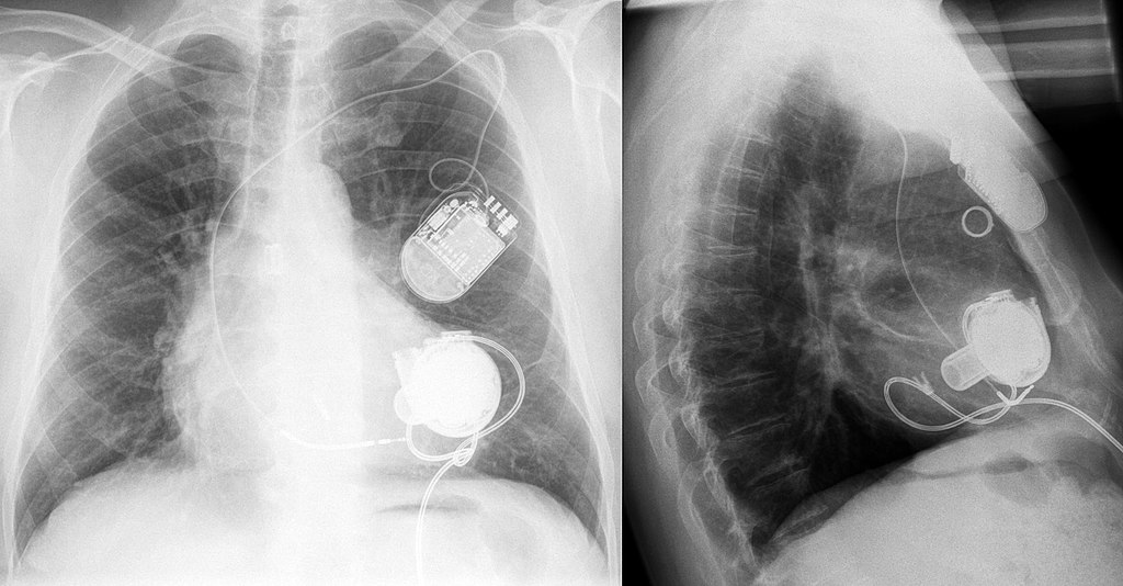 Kidney Disease Patients with Implantable Heart Defibrillators at Greater Risk of Hospitalization