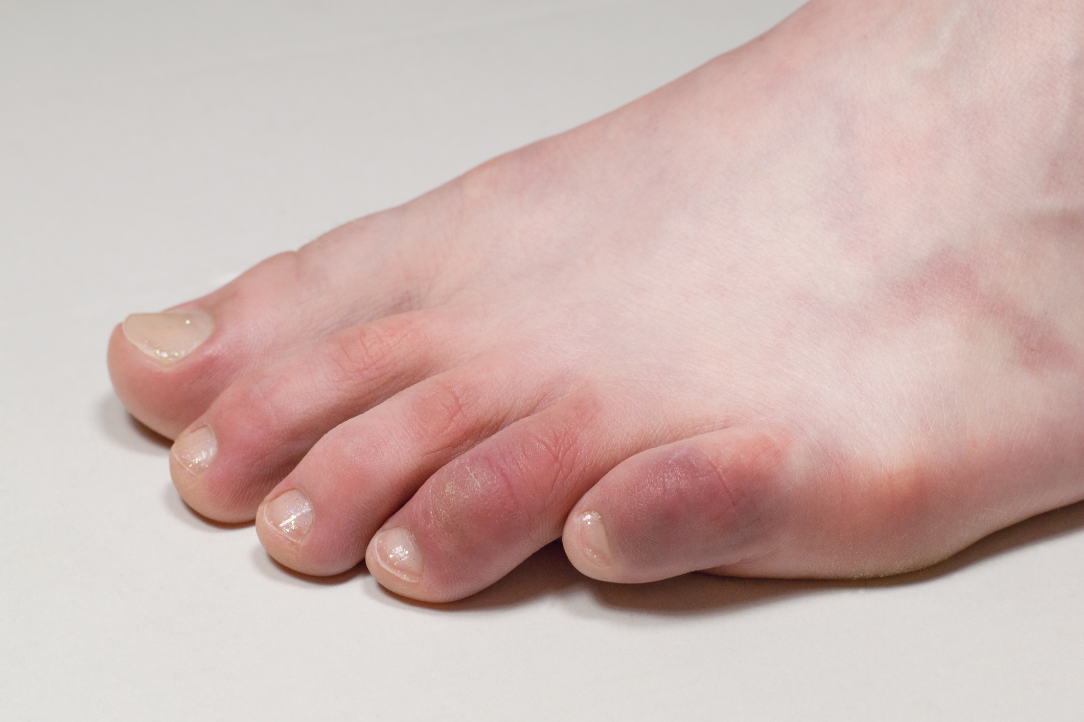 ‘COVID toes’ were likely not caused by COVID-19, in most cases